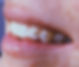 Tooth Jewelry, Tooth Gems, Dental Jewelry Diamonds - Twinkles.jpg