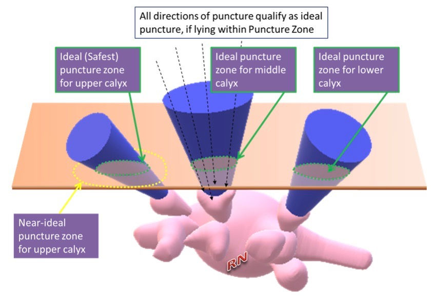 Puncture Zone Concept for PCNL Puncture