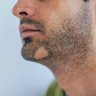 How to deal with beard hair loss?