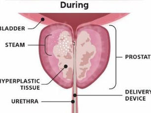 Rezum Therapy: A Hit or a Miss in Prostate Treatment?