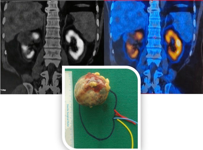 Sestamibi Scan