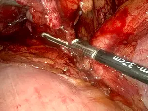Robotic-Assisted Radical Cystectomy Current evidence