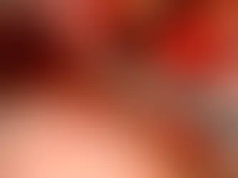 Robotic-Assisted Radical Cystectomy Current evidence