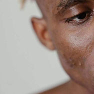 Men and Hyperpigmentation Stigma
