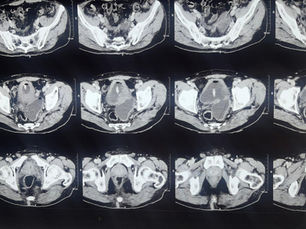Bladder diverticula - When & How to treat