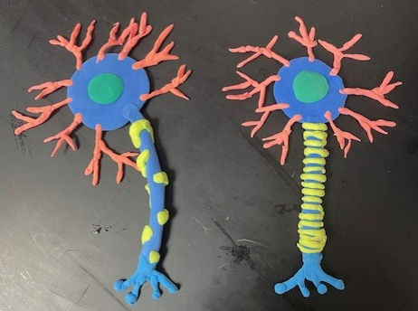 Multiple Sclerosis Neuron and a Healthy Neuron