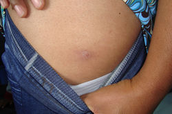 Picadura de triatomino