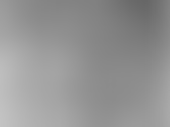 Segunda denervação renal em paciente com recidiva de hipertensão refratária