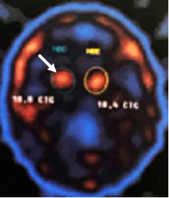 Doença de Parkinson Cirurgia e a Inteligência Artificial
