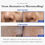 Thumbnail: Zero Exosome Shot 2000- Microneedling in a bottle