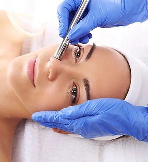 MIcrodermabrasion Marlowe