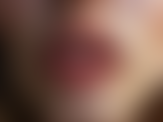 Transformations with Lip Fillers: Before and After