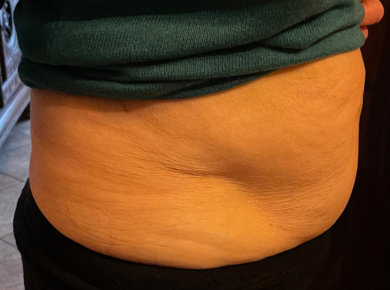 Bild 2 seitlich vor der Behandlung Rektusdiastase Bauch-Fit mit FSM.