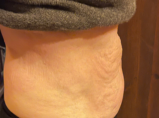 Bild 2 seitlich nach der Behandlung Rektusdiastase Bauch-Fit mit FSM.