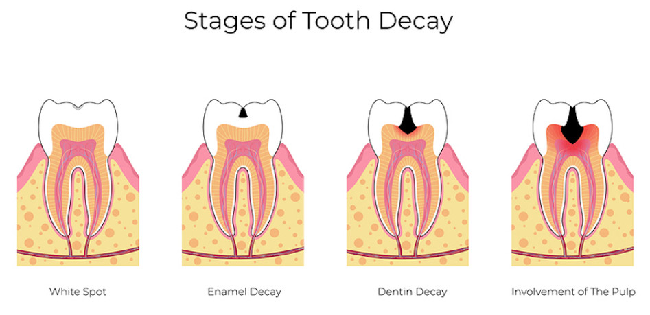 dentist-ped-stages-cavity-350098669.jpg