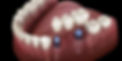 implant.jpeg