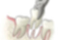 Tooth-extraction-Minor-surgery.jpeg