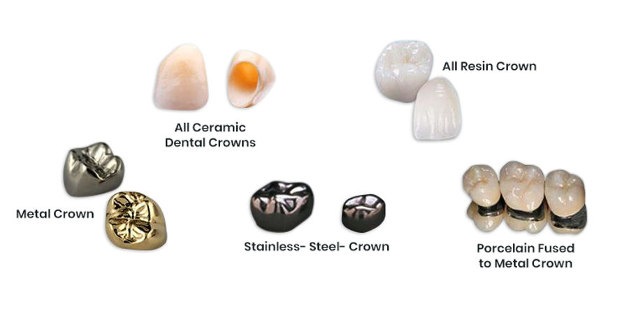 types of crown.jpeg