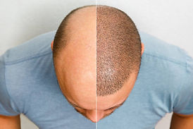 hair transplant before and after | CuraVoy