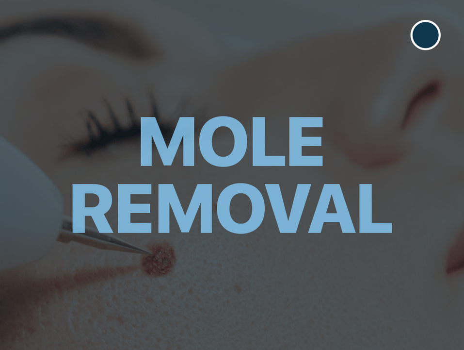 Mole Removal & Checks