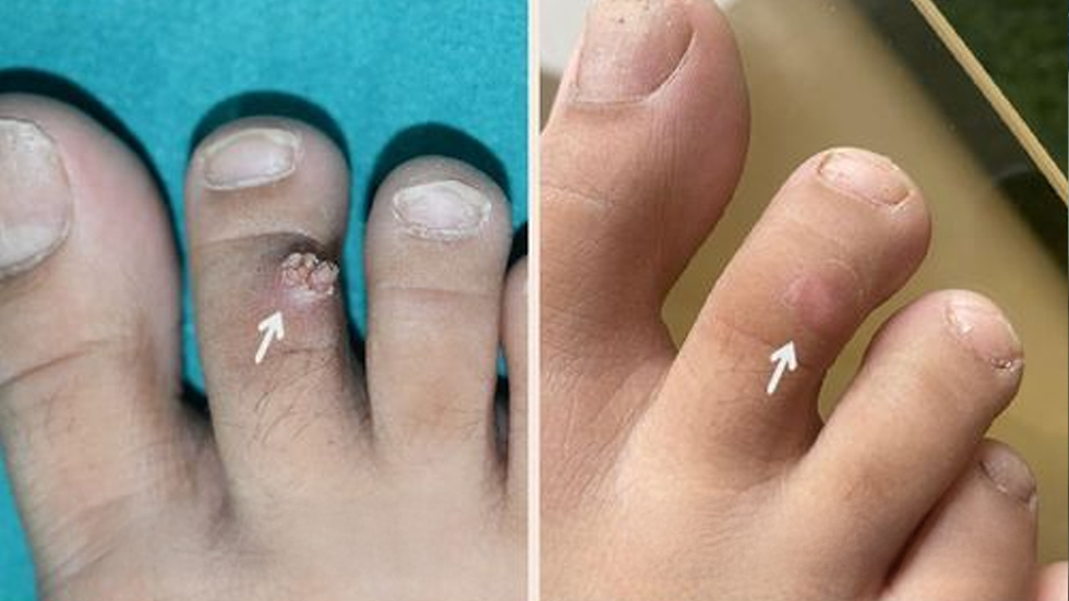 wart-1.png