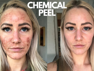 Are There Potential Side Effects of Chemical Peels Treatment?