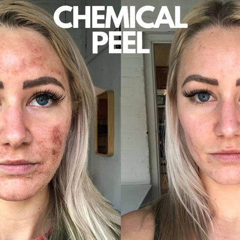 Are There Potential Side Effects of Chemical Peels Treatment?