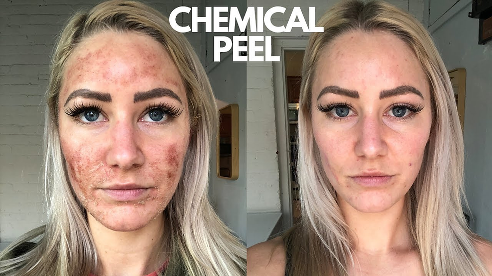 Are There Potential Side Effects of Chemical Peels Treatment?
