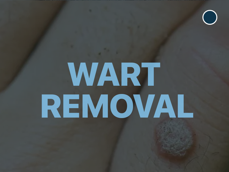 Wart Removal