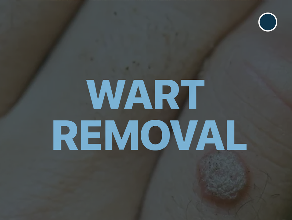 Wart Removal
