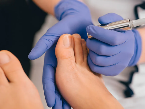 What Else Needs to Happen Other Than the Laser Session for Fungal Nail Treatment?