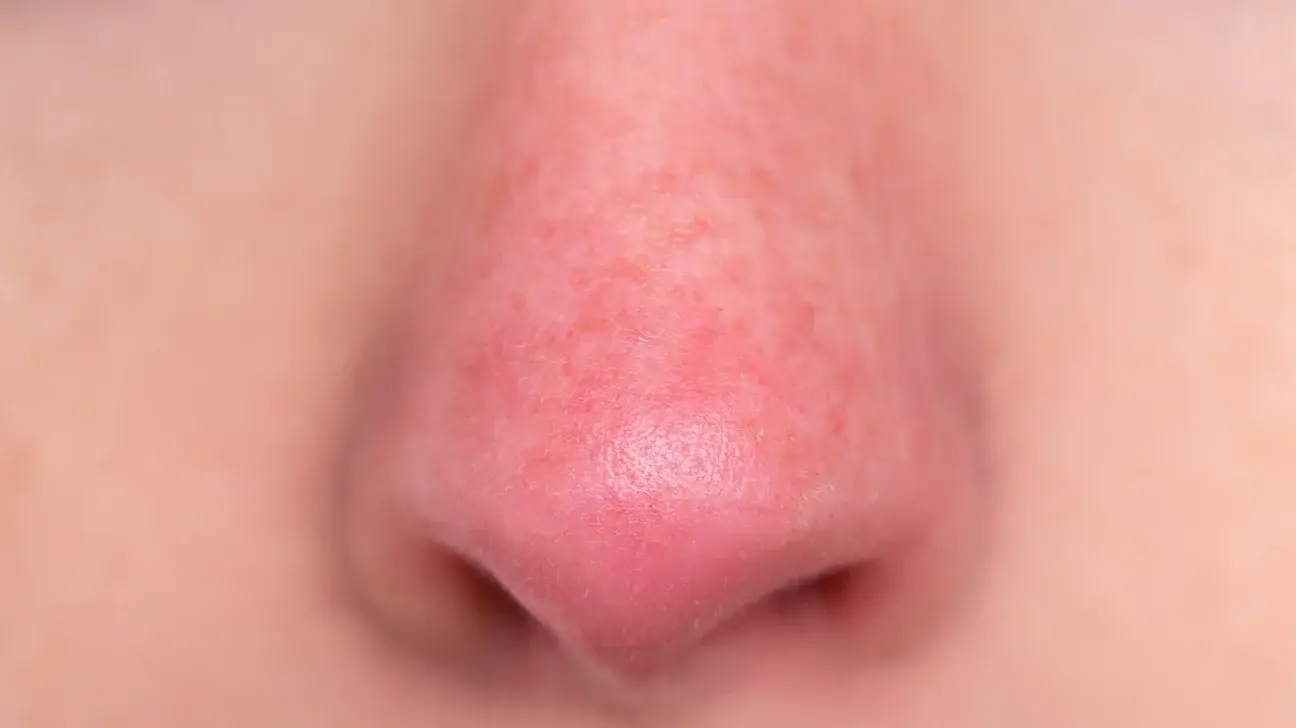 laser nose