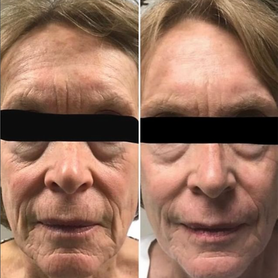 Wrinkles - Blossom Medspa.png