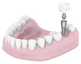 62073241-0-dental-implant.webp