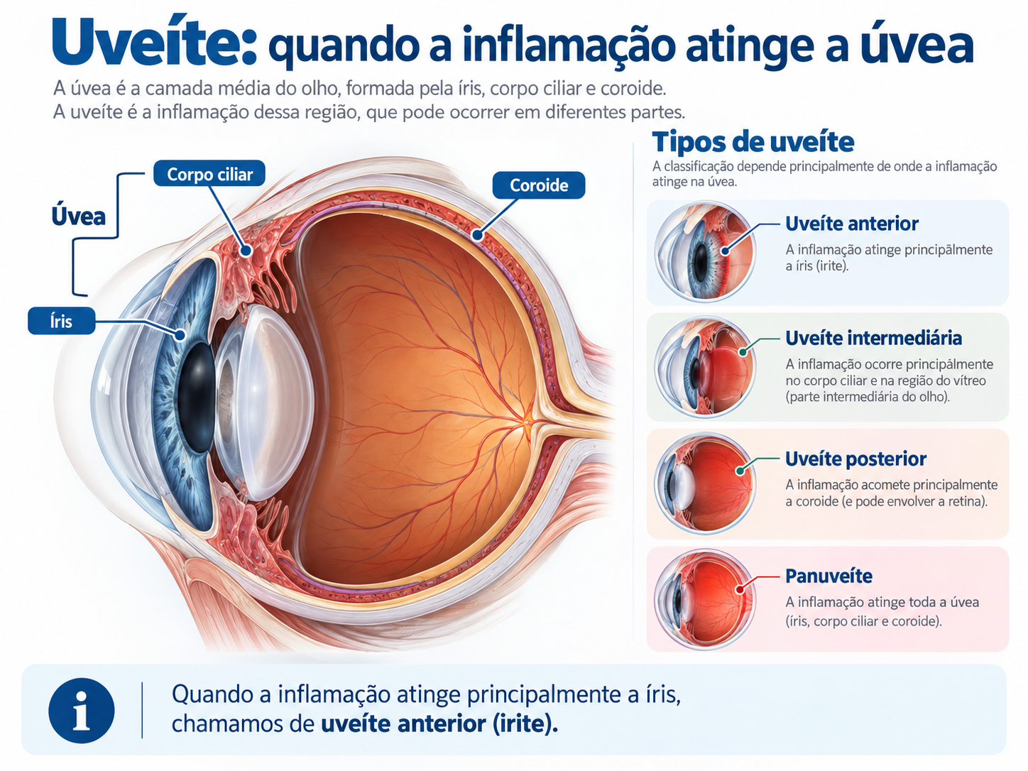 Infográfico mostrando íris, corpo ciliar e coroide e a classificação em uveíte anterior, intermediária, posterior e panuveíte