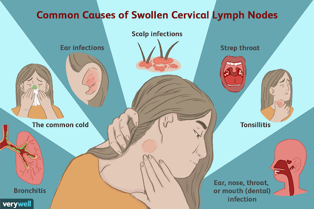 Common Causes of Neck Swelling