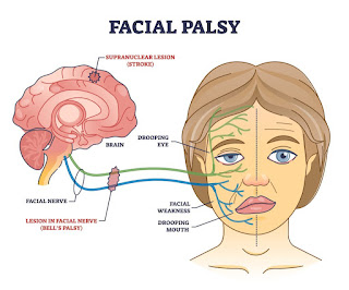 Best facial palsy surgeon in Chennai | Dr Sanjeev mohan