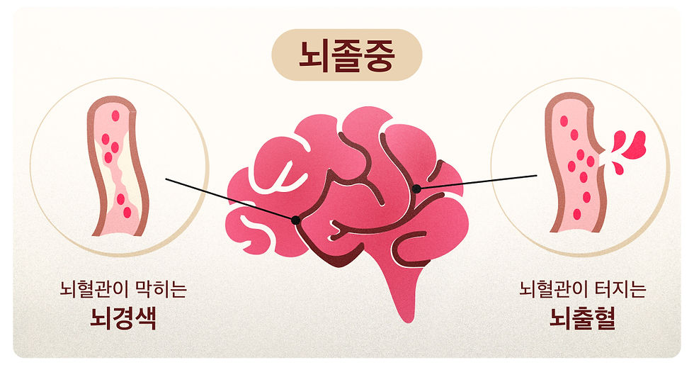 뇌경색-뇌졸중-뇌출혈-차이-한눈에