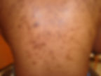 Hyperpigmentation