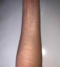 Self-Harm Scars
