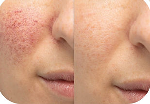 ROSACEA LASER