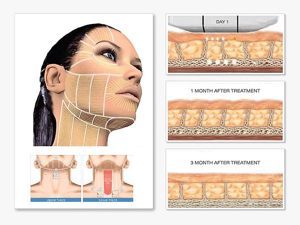 HIFU - ULTHERAPY