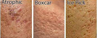 Depressed Scars