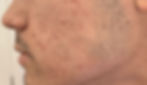 Hyperpigmentation