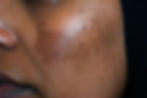 melasma