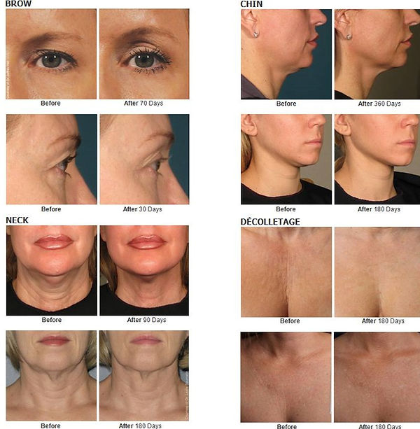 HIFU - ULTHERAPY