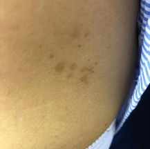 Pigmented Scars