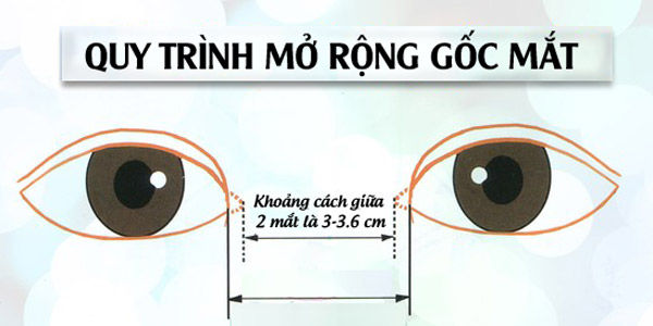 Những trường hợp nào nên mở rộng góc mắt trong? 3