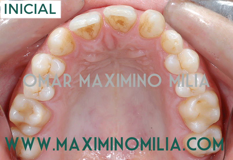 MENDIVIL-OCLUSAL-BKTS.gif