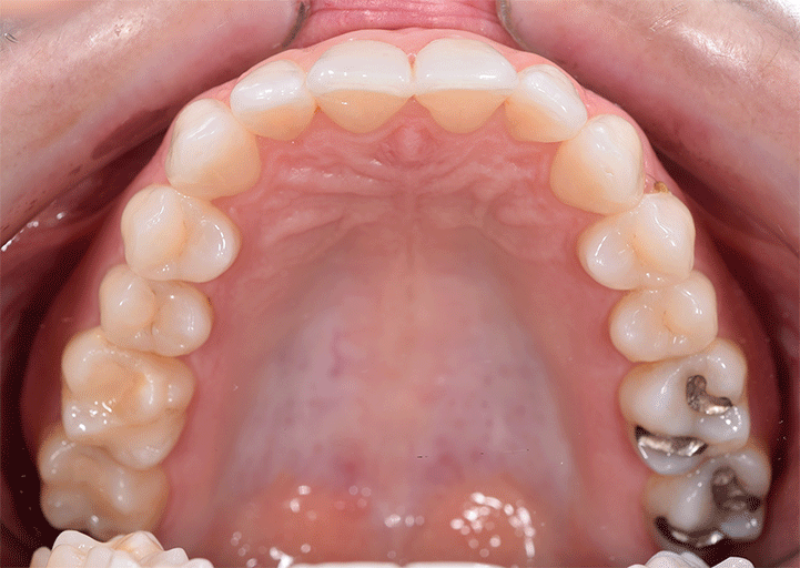 LAURA-TODAS-A-INICIALES-ANTES-Y-DESPUES-